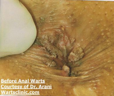 anal warts